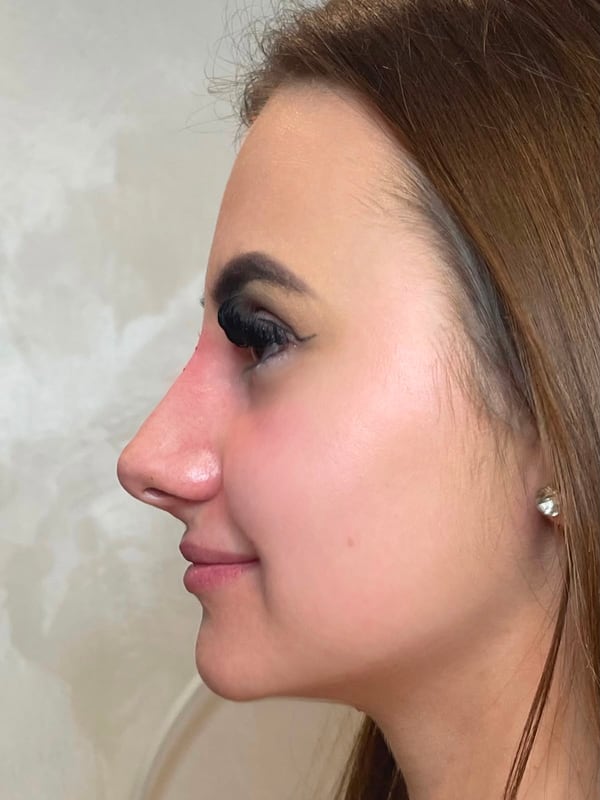 Profile Refinement, after, example 1