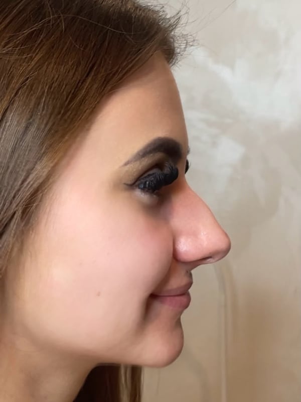 Profile Refinement, before, example 1