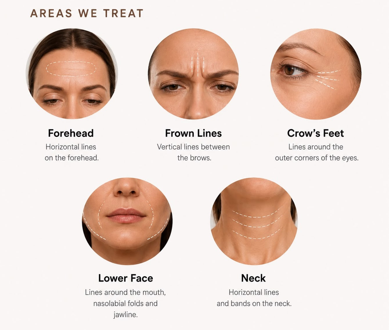 Areas we treat: forehead (horizontal lines), frown lines (vertical lines between the brows), crow's feet (lines around the outer corners of the eyes), lower face (lines around the mouth, nasolabial folds and jawline) and neck (horizontal lines and bands)