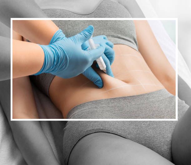 A body contouring treatment being administered in clinic